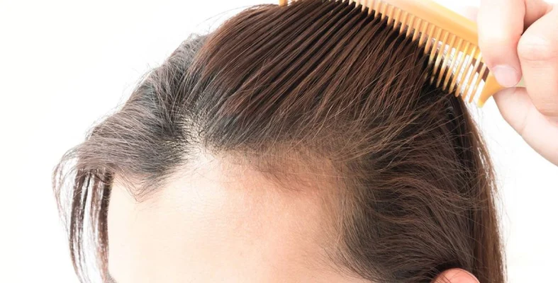 Hair Loss Treatment for Women