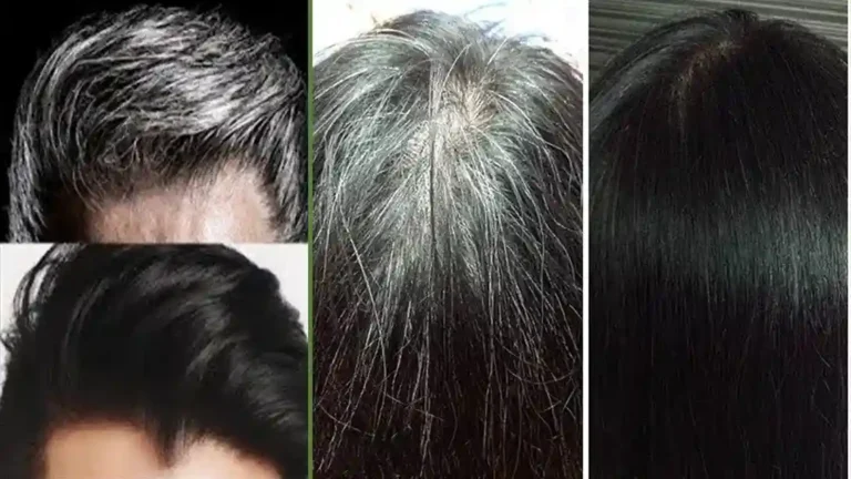 علاج تساقط الشعر