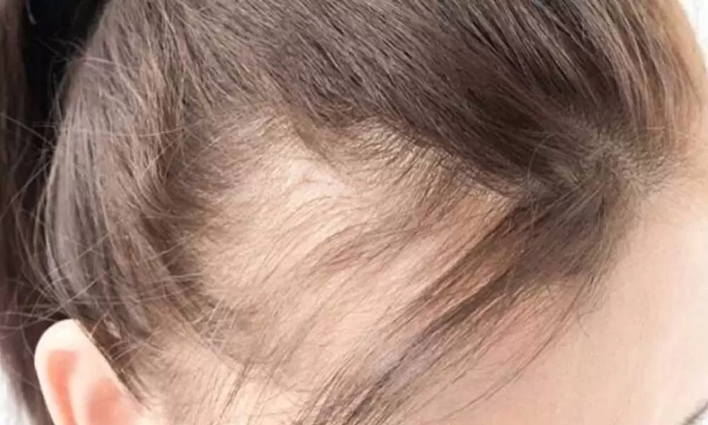 علاج تساقط الشعر للنساء